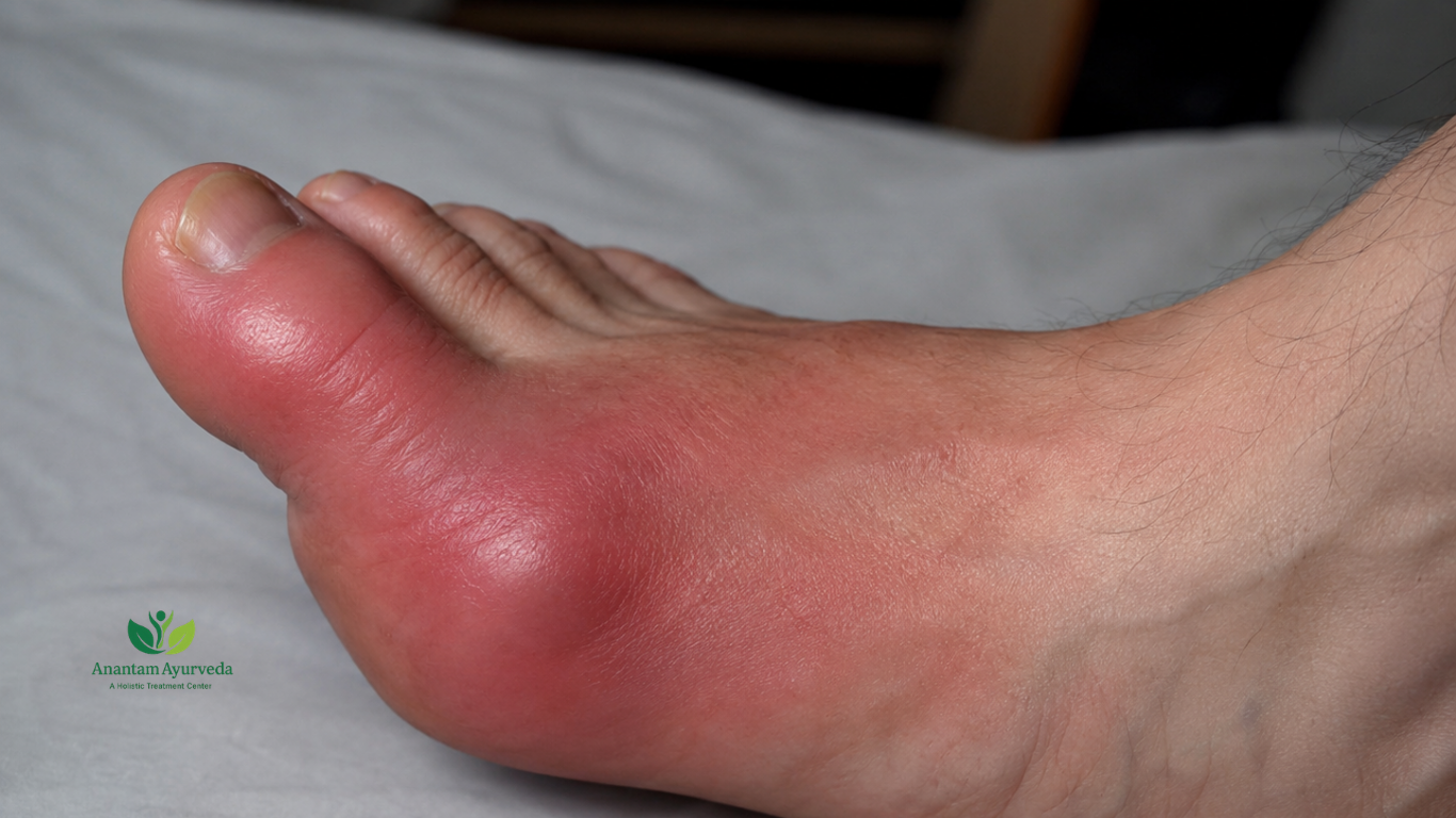 High Uric Acid