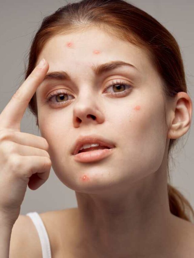 Symptoms of Acne