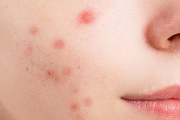 Treatment of Acne in Ayurveda