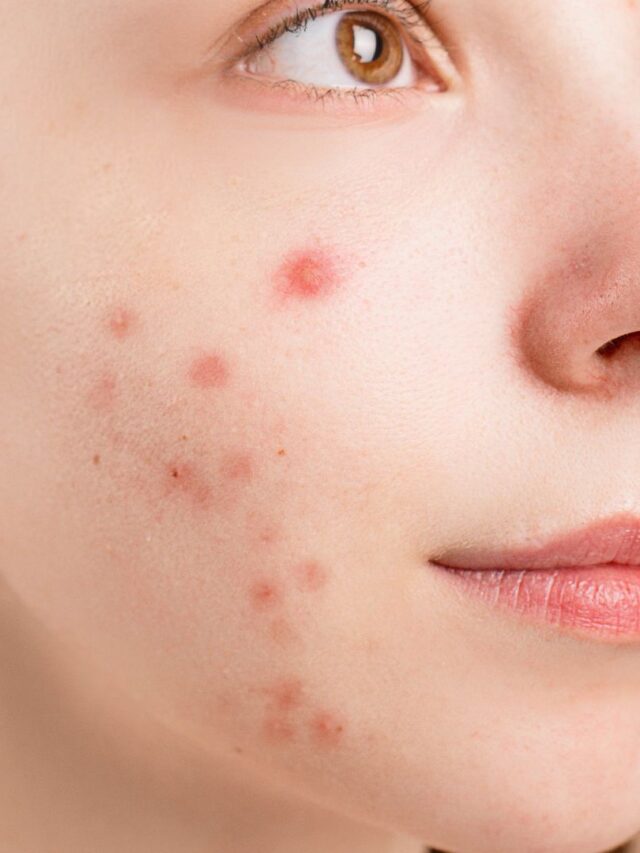 Treatment of Acne in Ayurveda