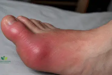 High Uric Acid